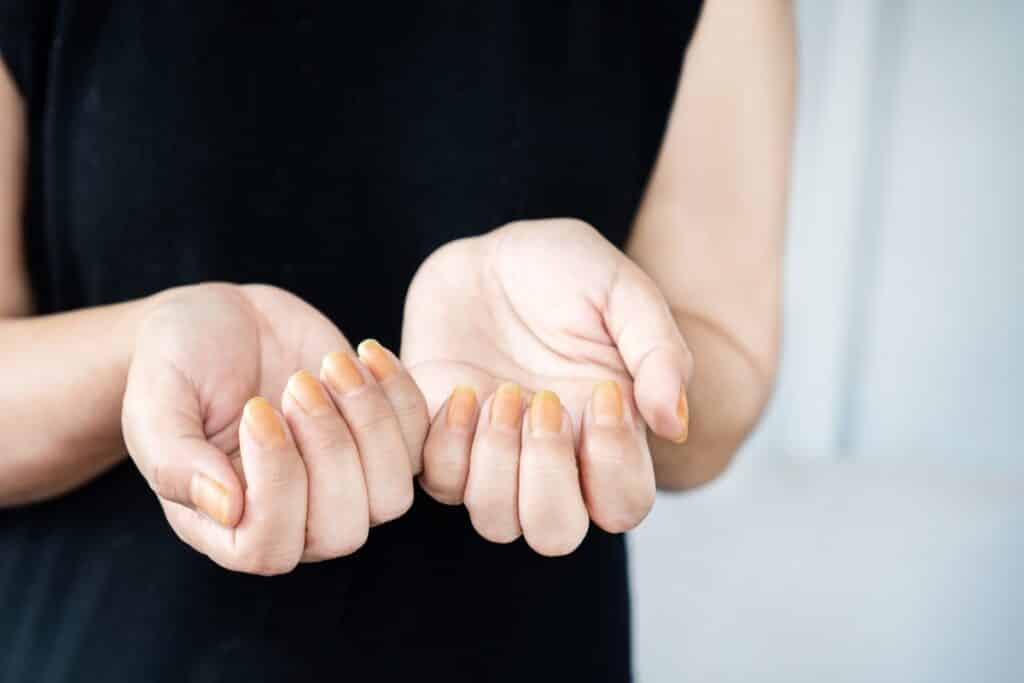 ongles jaunis